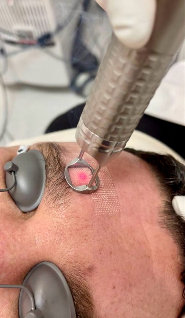 Pico Pulse Dark Spot Treatment