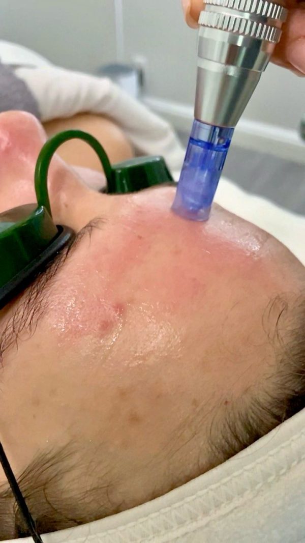 PRP (Whole Face)